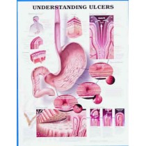 Understanding Ulcers Chart