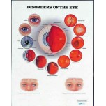 Disorders Of The Eye Chart