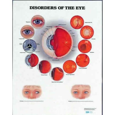 Disorders Of The Eye Chart