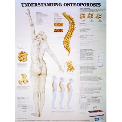 Understanding Osteoporosis Chart