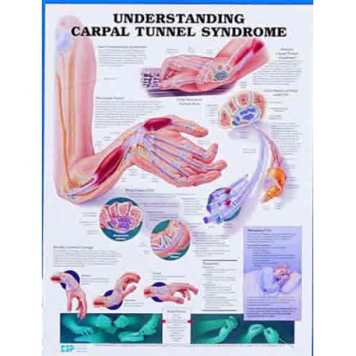 Understand Carpal Tunnel Chart