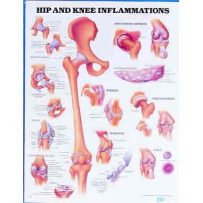 Hip & Knee Inflammation Chart.