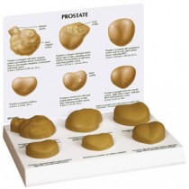 Prostate-set of 6 Budget Model