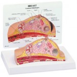 Breast Cross Section Budget Model Showing Pathologies