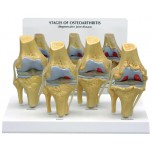 4-Stage Osteoarthritis Knee - Budget Model