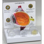 Cataract Eye - Budget Model