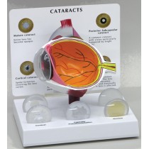 Cataract Eye - Budget Model