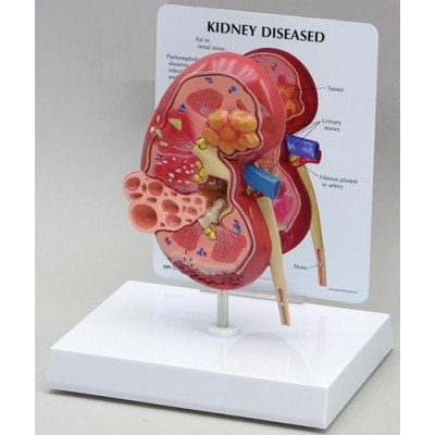 Kidney Cancer Oversize - Budget Model