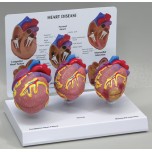 3-Mini Heart Set - Budget Model