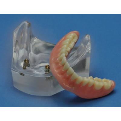 Dental Implant Overdenture Model with Two Locator Inserts