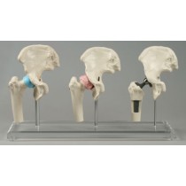 Hip Implant Model - Set of 3 Joints
