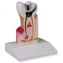Dental Caries Model, 10x Life Size
