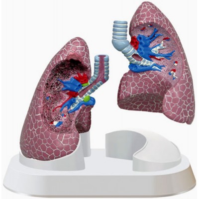 Lung Pathologies