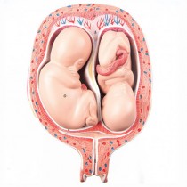 Twin Foetuses In 5th Month